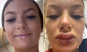 bruising after lip injections