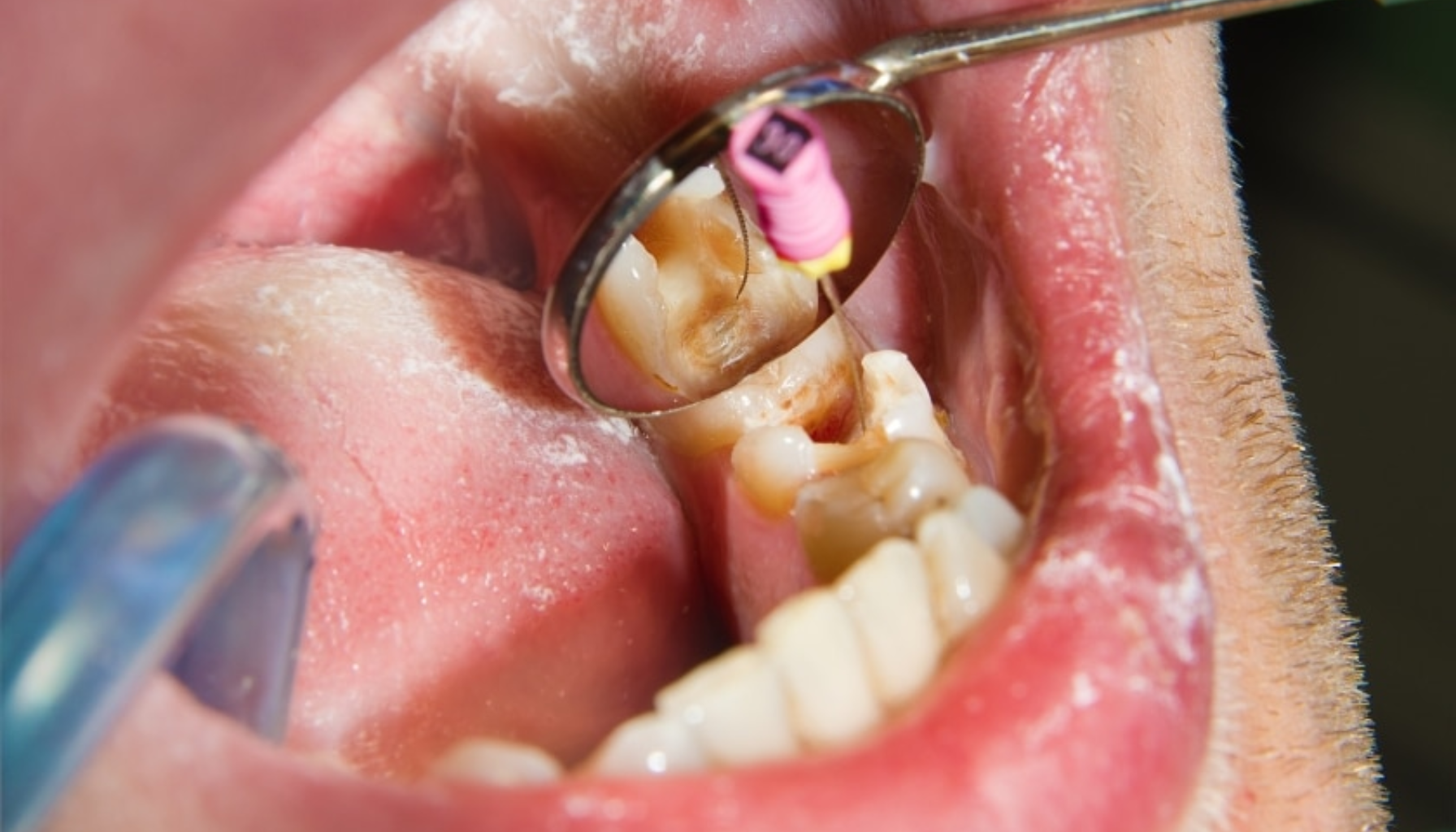 Tannlege som undersøker en tann med hulrom ved hjelp av speil i munnen.