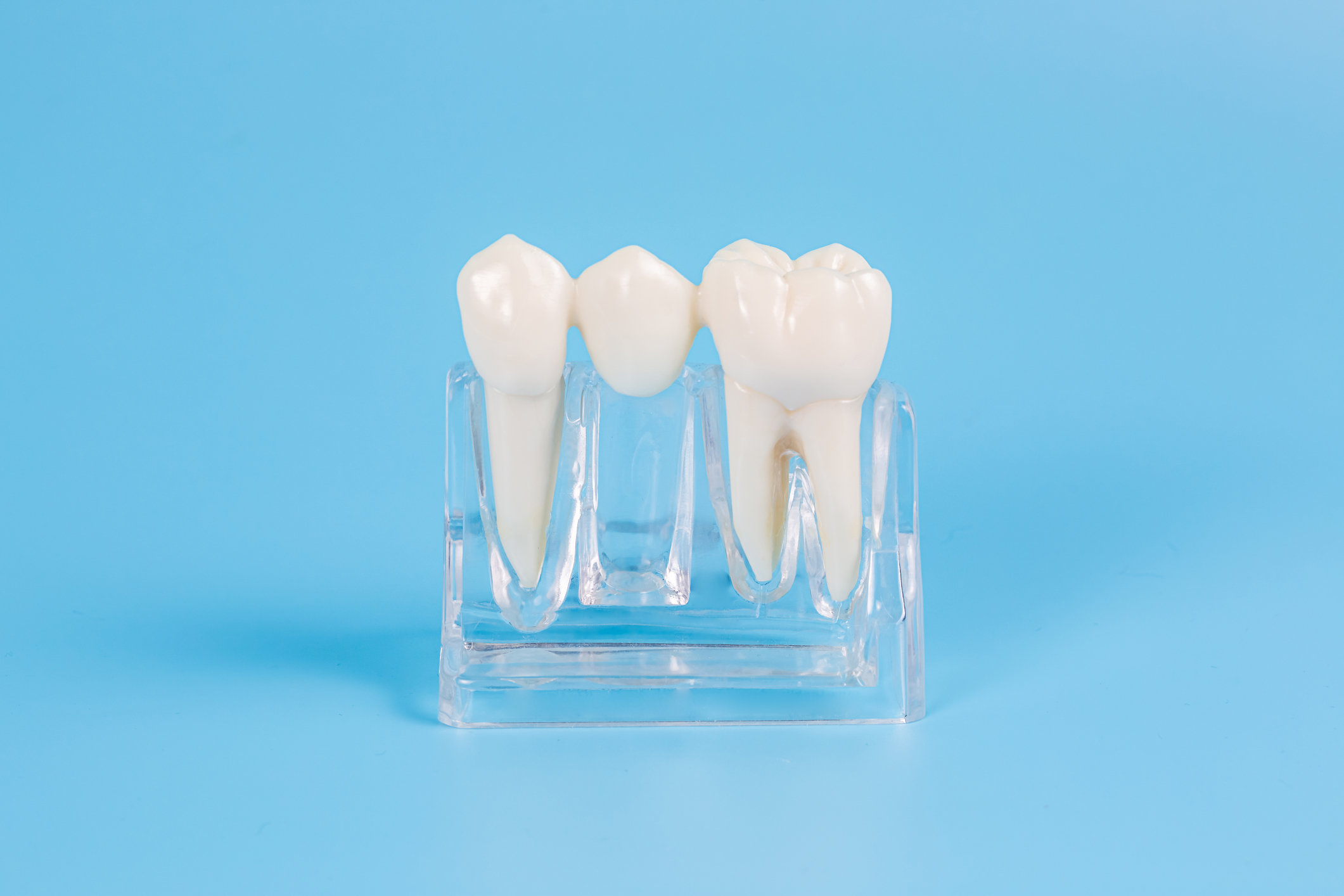 the nest treatment for a replacement tooth might be a bridge