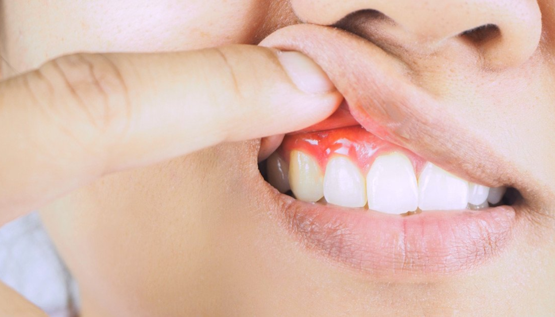 Nærbilde av tannkjøttbetennelse der en person løfter leppen for å vise rødt og irritert tannkjøtt.