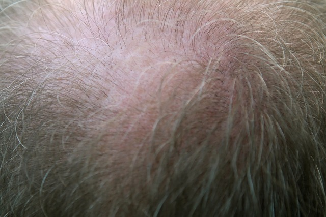 adult, bald, balding