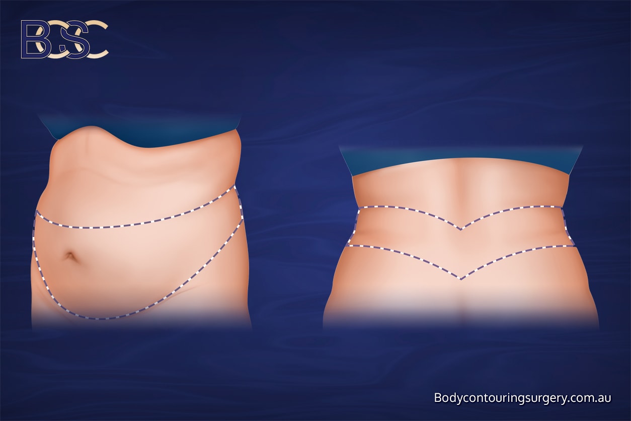 Belt lipectomy Belt lipectomy
