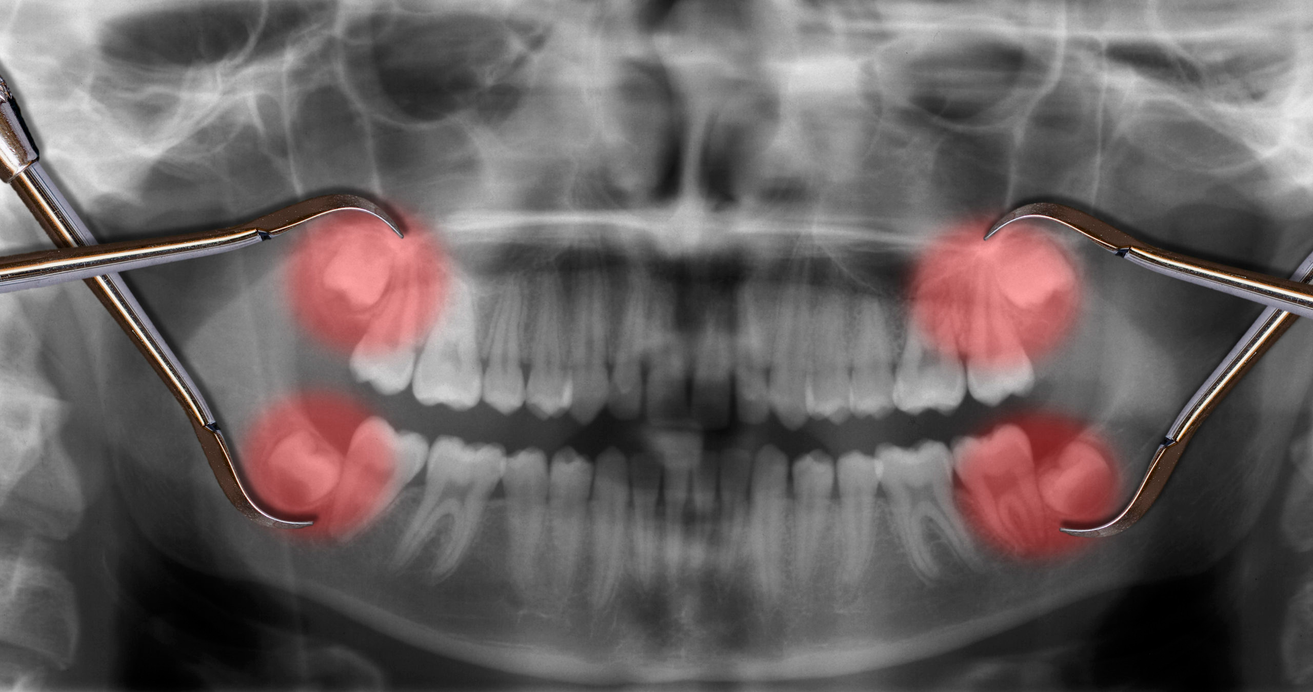 x ray showing wisdom teeth that are impacted and need to be removed