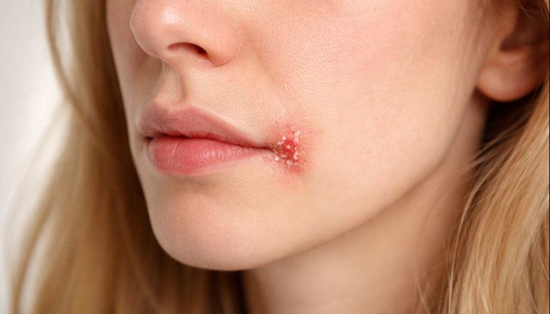 Rød og sprukken hud i munnviken som viser betennelse typisk for munnvikssår.