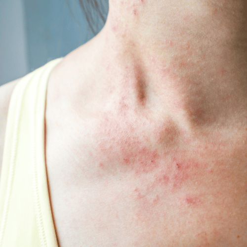 Relieving Eczema Symptoms 