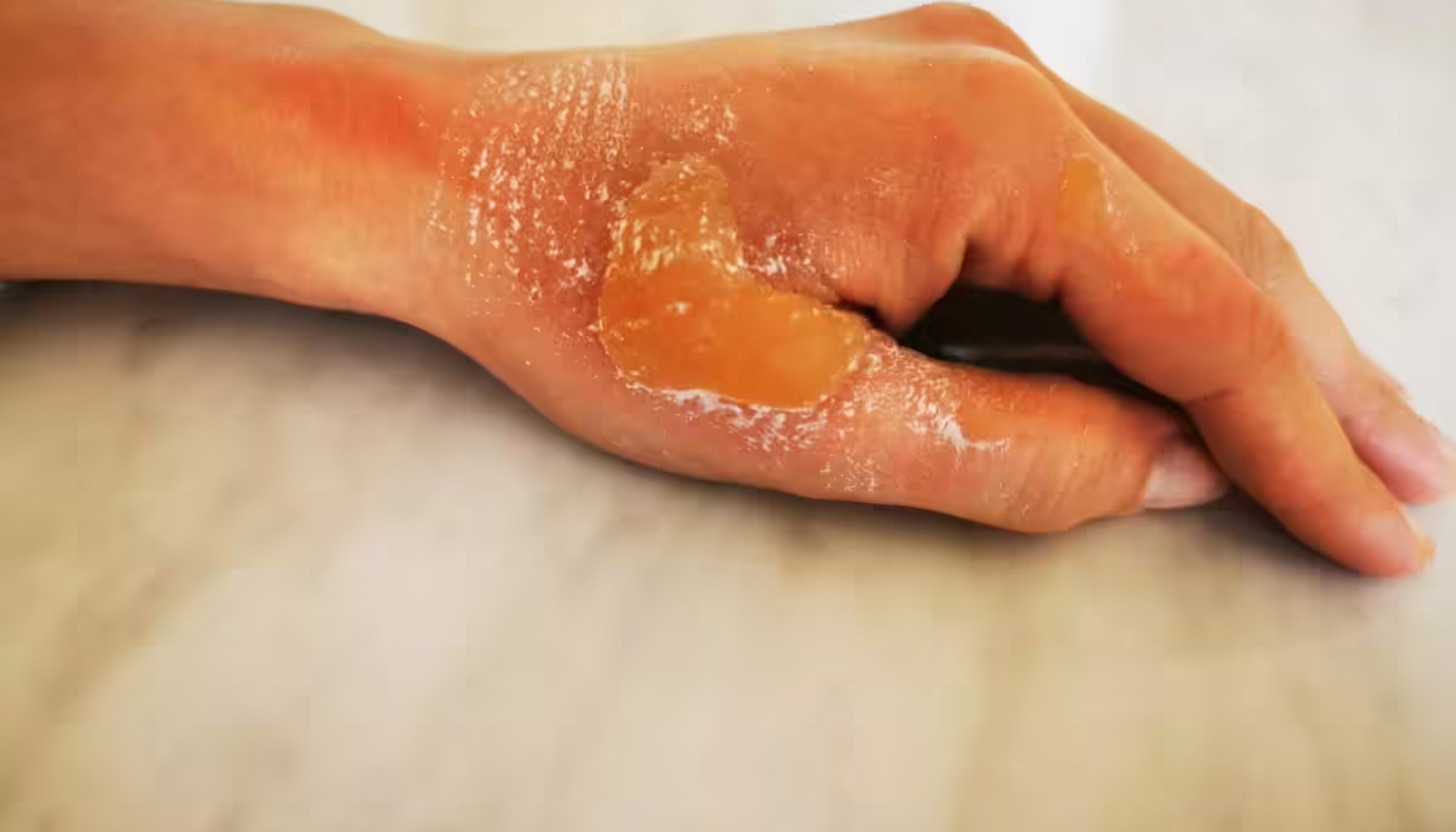 Medisinsk honning – Naturlig hjelp mot sår og infeksjoner 14 Hånd med medisinsk honning på huden brukt som naturlig behandling for sår og infeksjon.