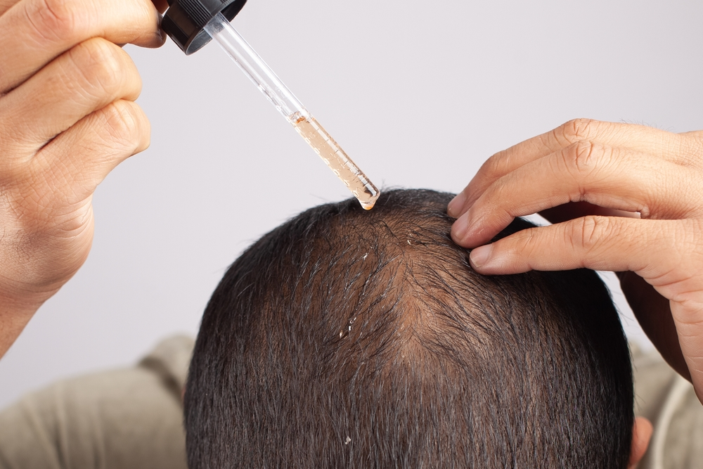 Man applying topical treatment to his crown, which shows evidence of hair loss