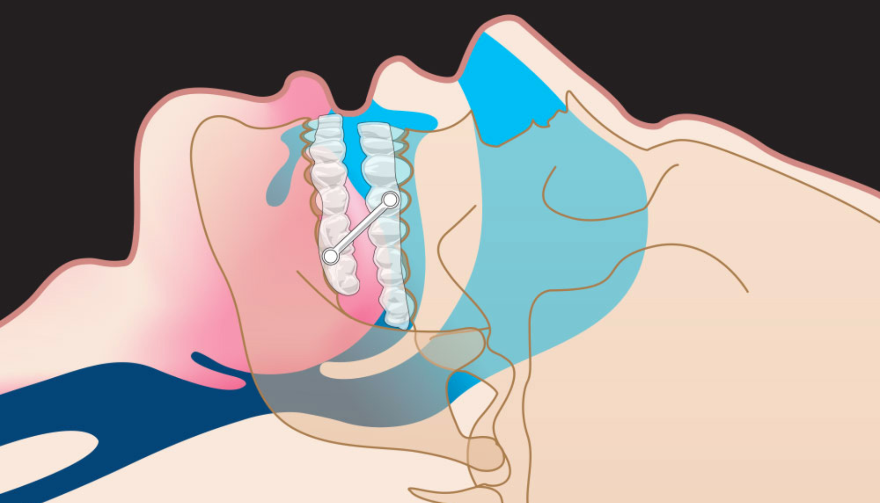 Snorkeoperasjon: Hva betyr det for tannhelsen? 14 "Illustrasjon av snorkeskinne som holder underkjeven fremover for å åpne luftveiene under søvn."