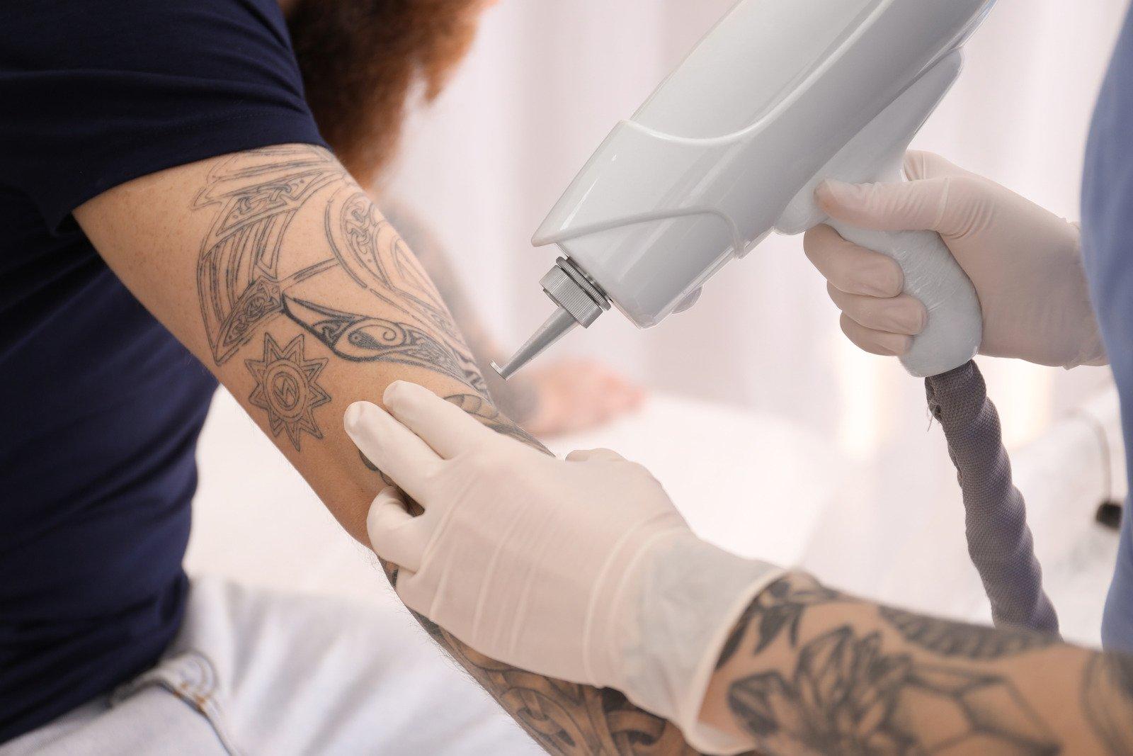 tattoo removal method, tattooed skin, Tattoo removal
