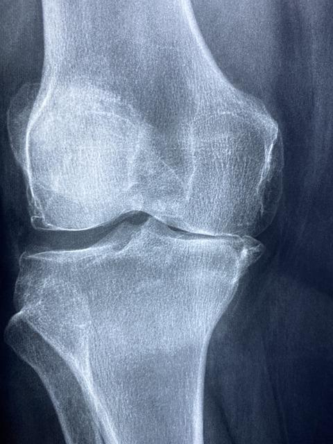 knee, x rays, arthritis