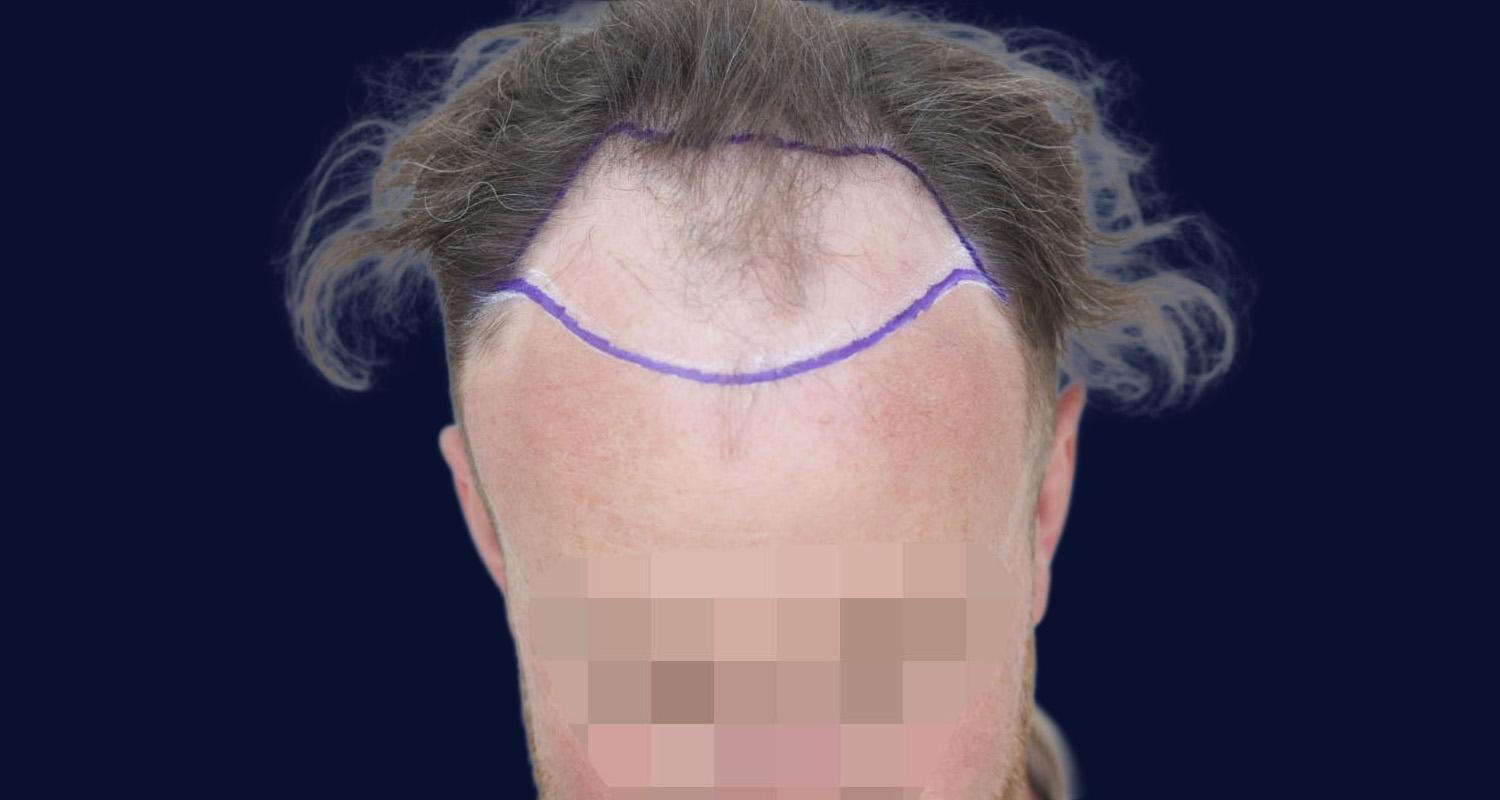 Dr Kunnure Clinic- Hair Transplant - Natural Hairline