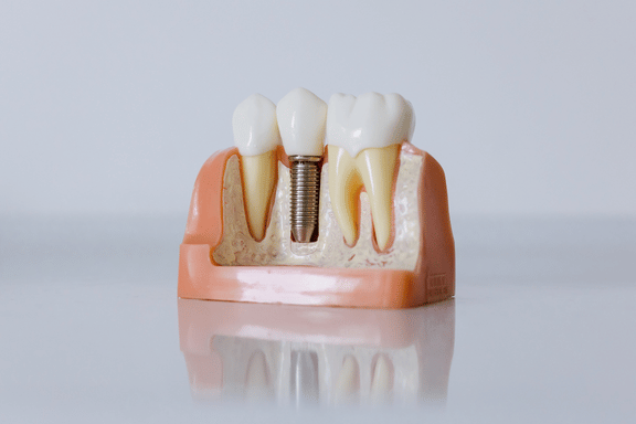 dental model of a titanium implant