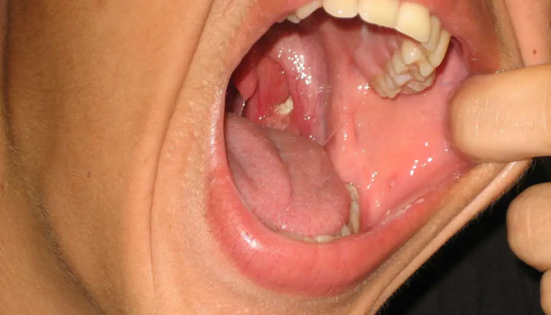 «Åpen munn med synlig betent og rød hals med hvite prikker, og fingre som drar kinnet til siden.»