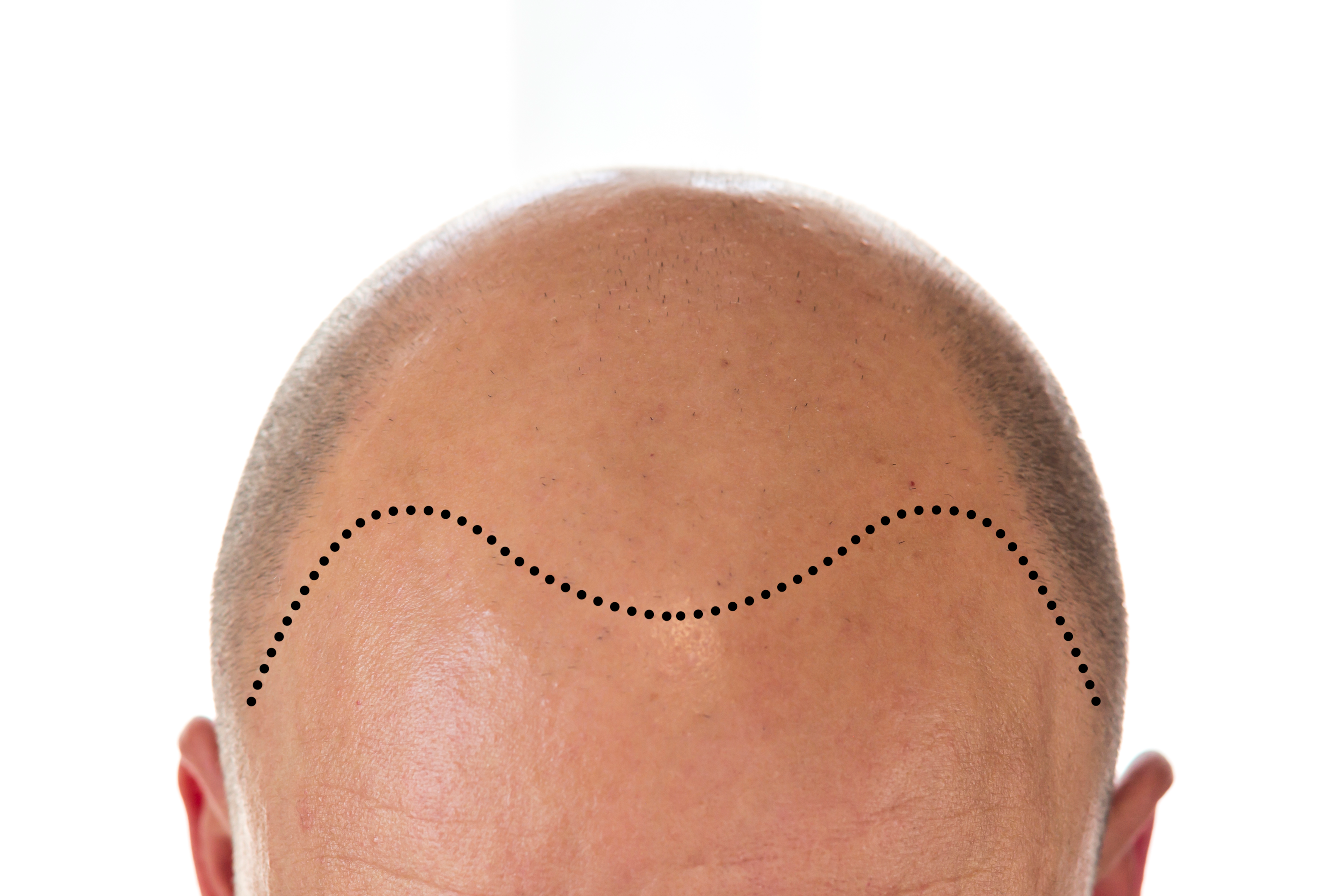 A classical 'M' shaped receding hairline.