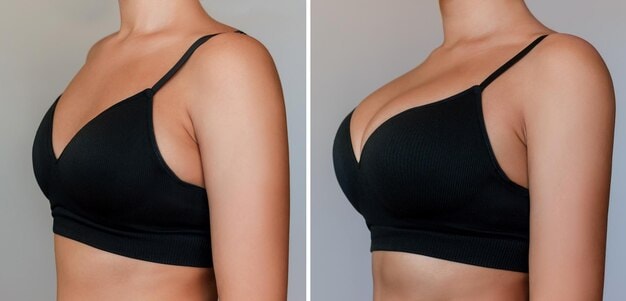 Breast lift