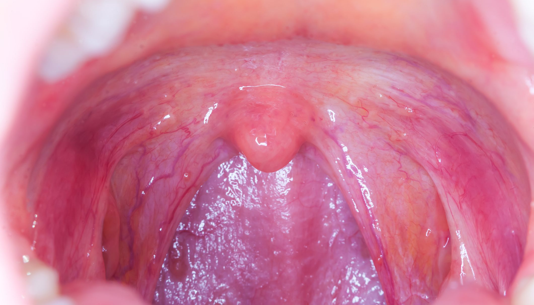 Nærbilde av en rød og betent hals med synlig drøvel og slimhinner, muligens tegn på infeksjon eller irritasjon.