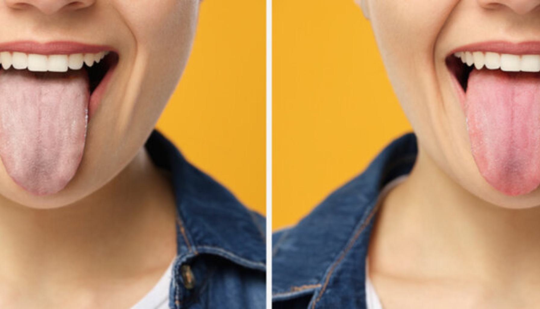 To bilder av tunge – én med hvitt belegg og én med sunn rosa tunge.