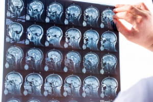 Common causes of brain injuries