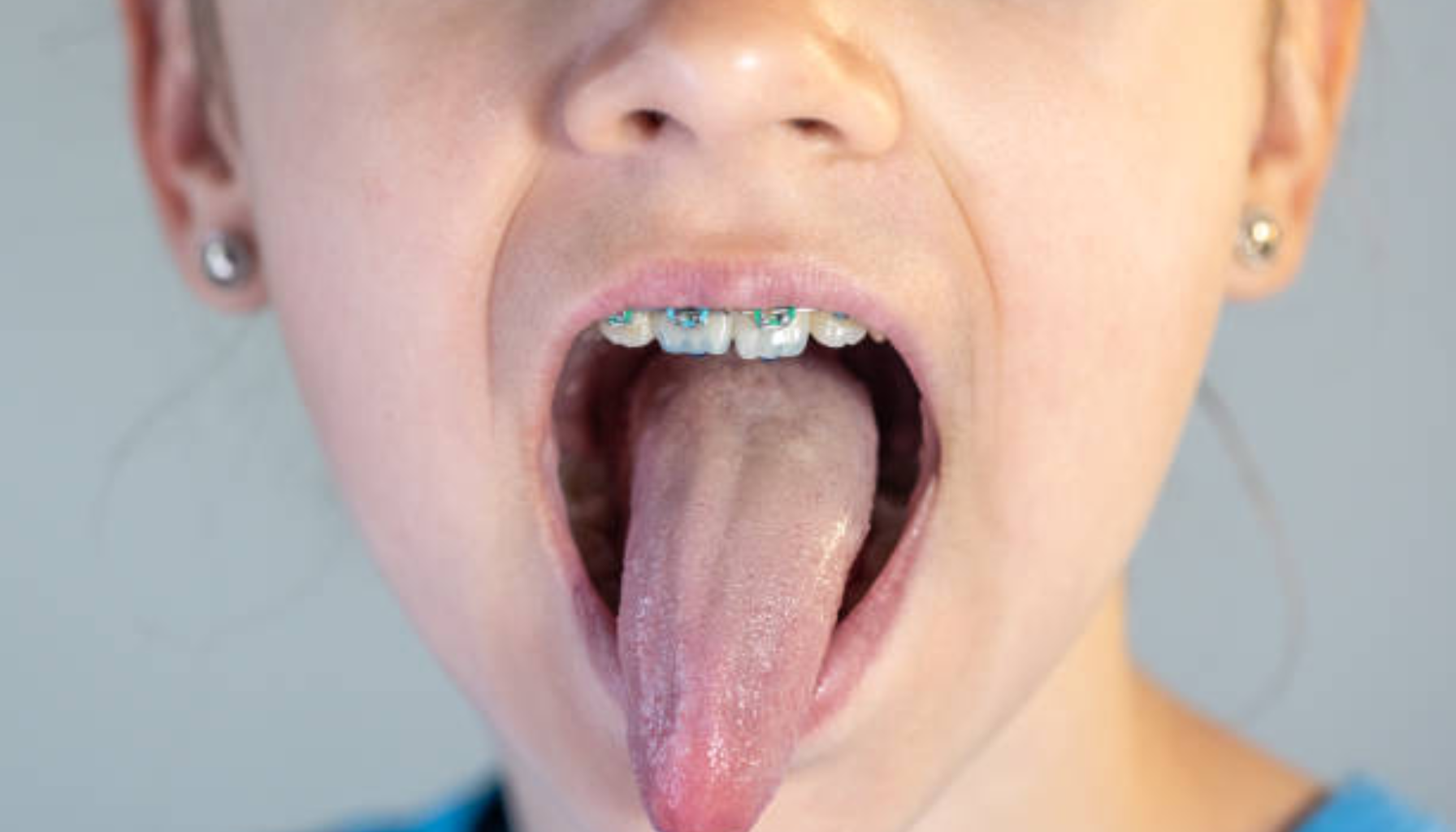 Nummen tunge: Når prikking og følelsesløshet ikke går over 10 Barn som rekker ut tungen med synlige reguleringstråder på tennene under nærbildeundersøkelse. nummen tunge nummenhet i tungen tungen tunge nummenhet symptomer munnen nummen andre følelse eksempel tegn munnhulen kroppen lege munn går ofte årsaker sår tilstand mer smerte sykdommer tunga vanlig slag prikking svie veldig årsaken skyldes tid annet følelsen tilfeller gir flere kommer smerter dag lite blant komme tilbake gjøre bruk vitamin rundt mye mulig brukes skjer ulike lavt problemer mat