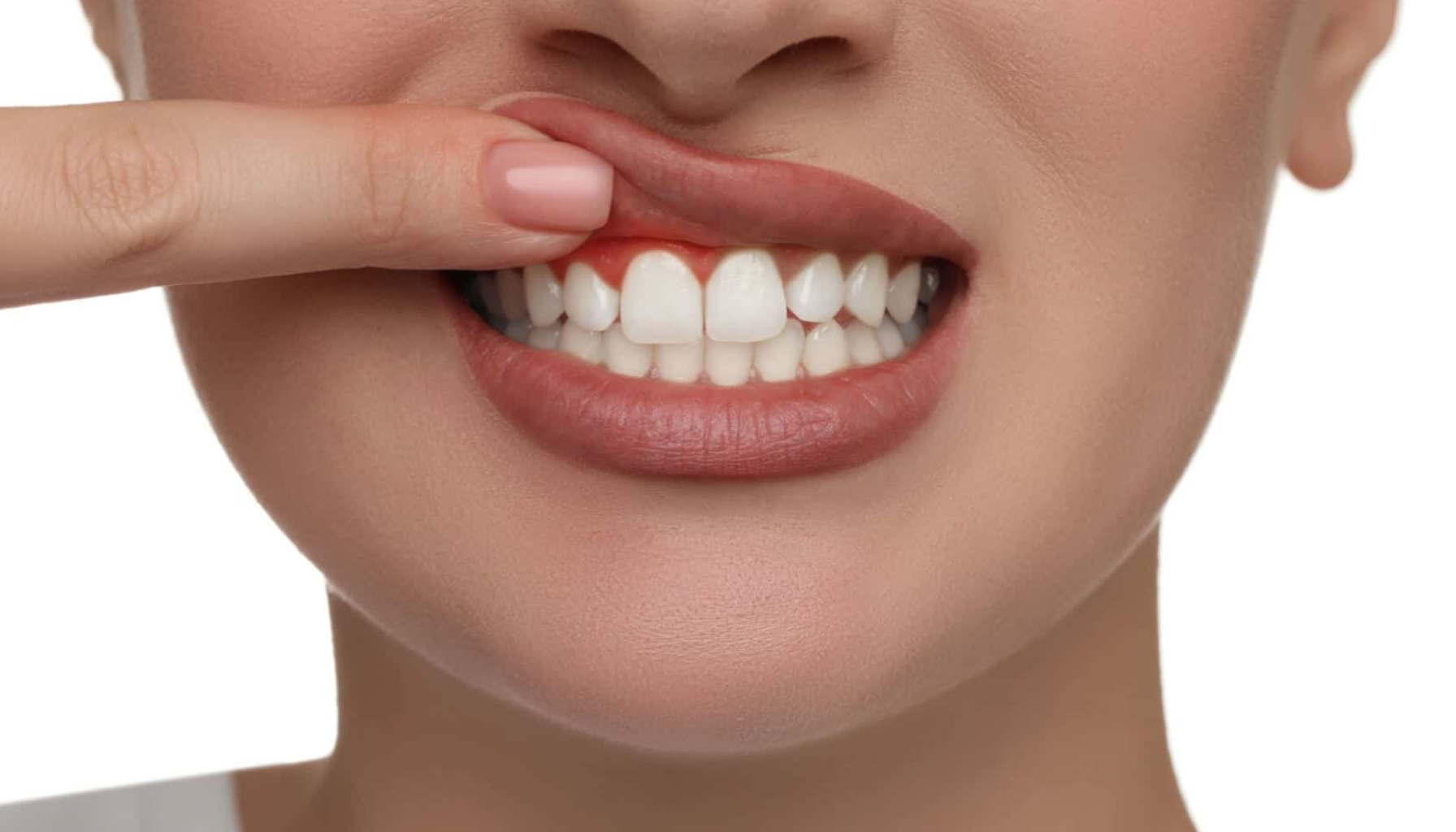 Kvinne løfter overleppen og viser rødt, betent tannkjøtt som tegn på tannkjøttsykdom.