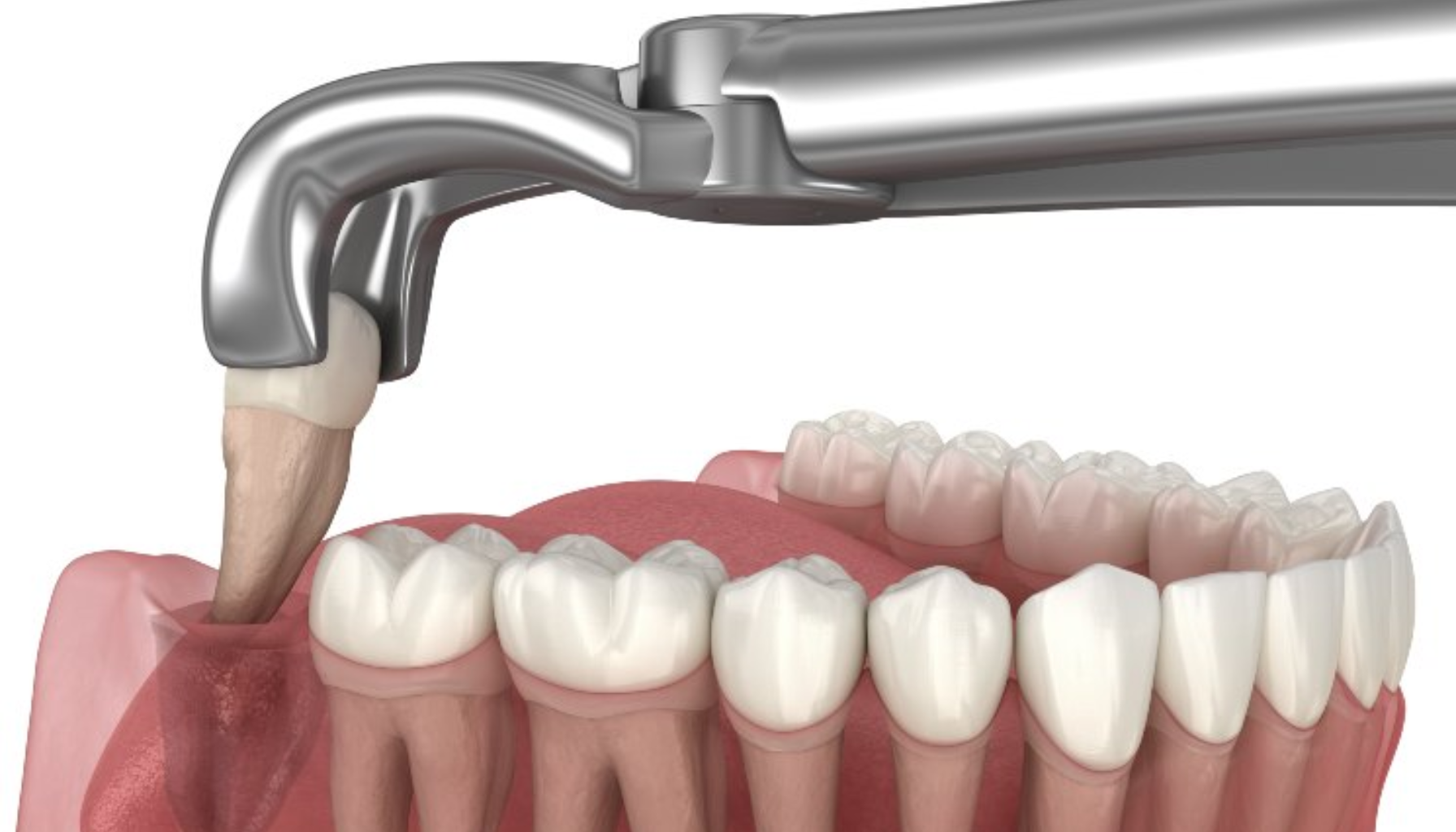Trekke visdomstann pris