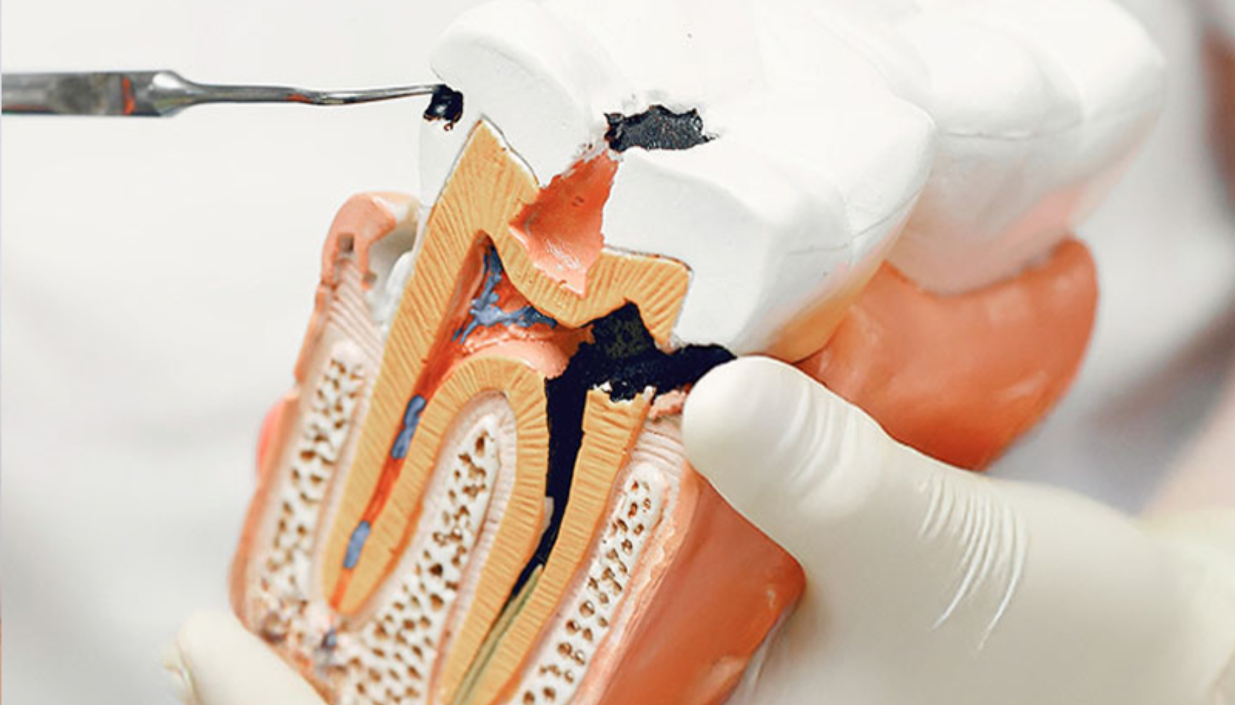 Modell av tann viser alvorlig karies som har trengt gjennom emaljen og inn i tannens indre struktur.