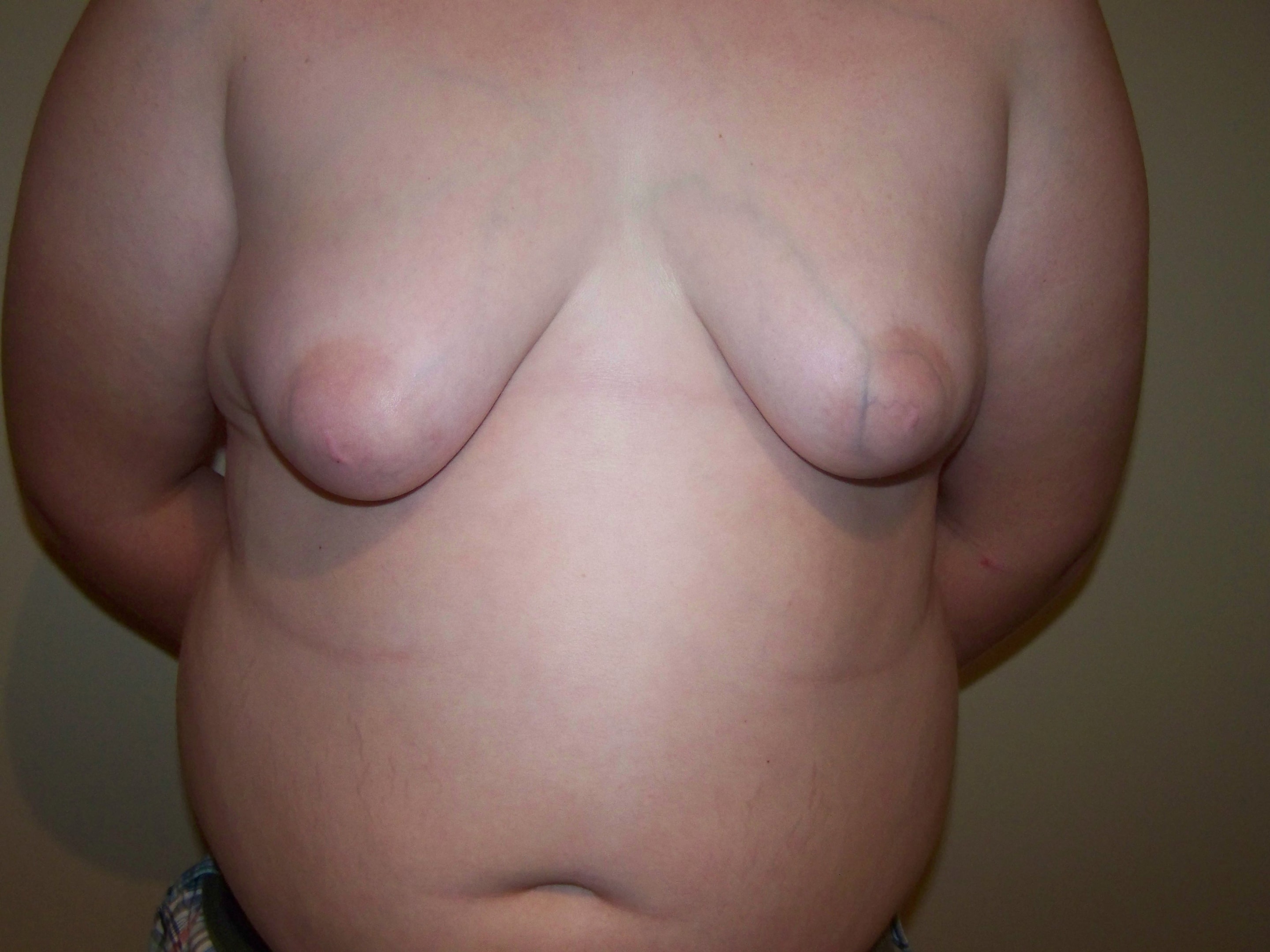 A patient of Dr. Delgado who is 14 yrs old with adolescent gynecomastia.