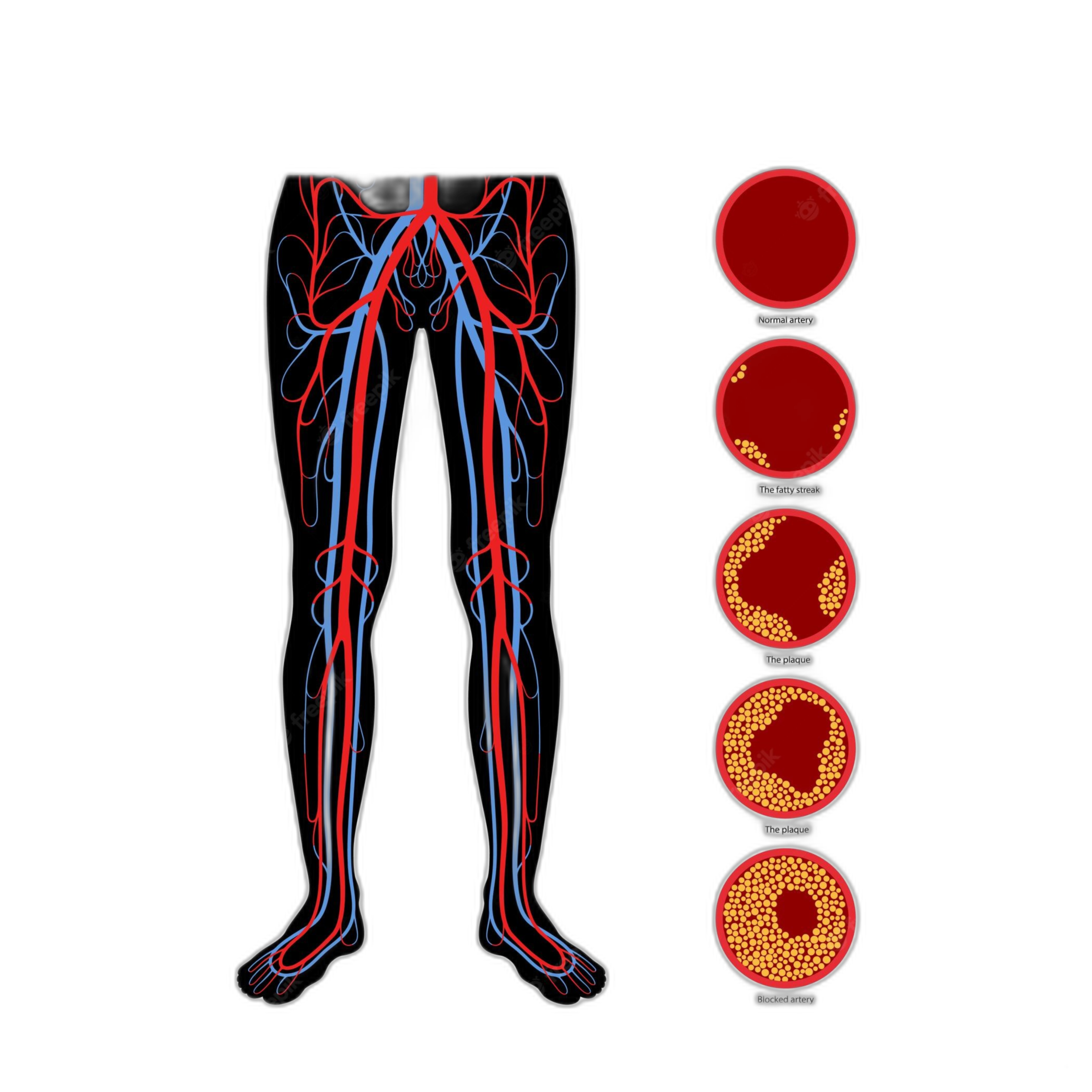 Peripheral Artery Disease Pad How Its Diagnosed And Treated