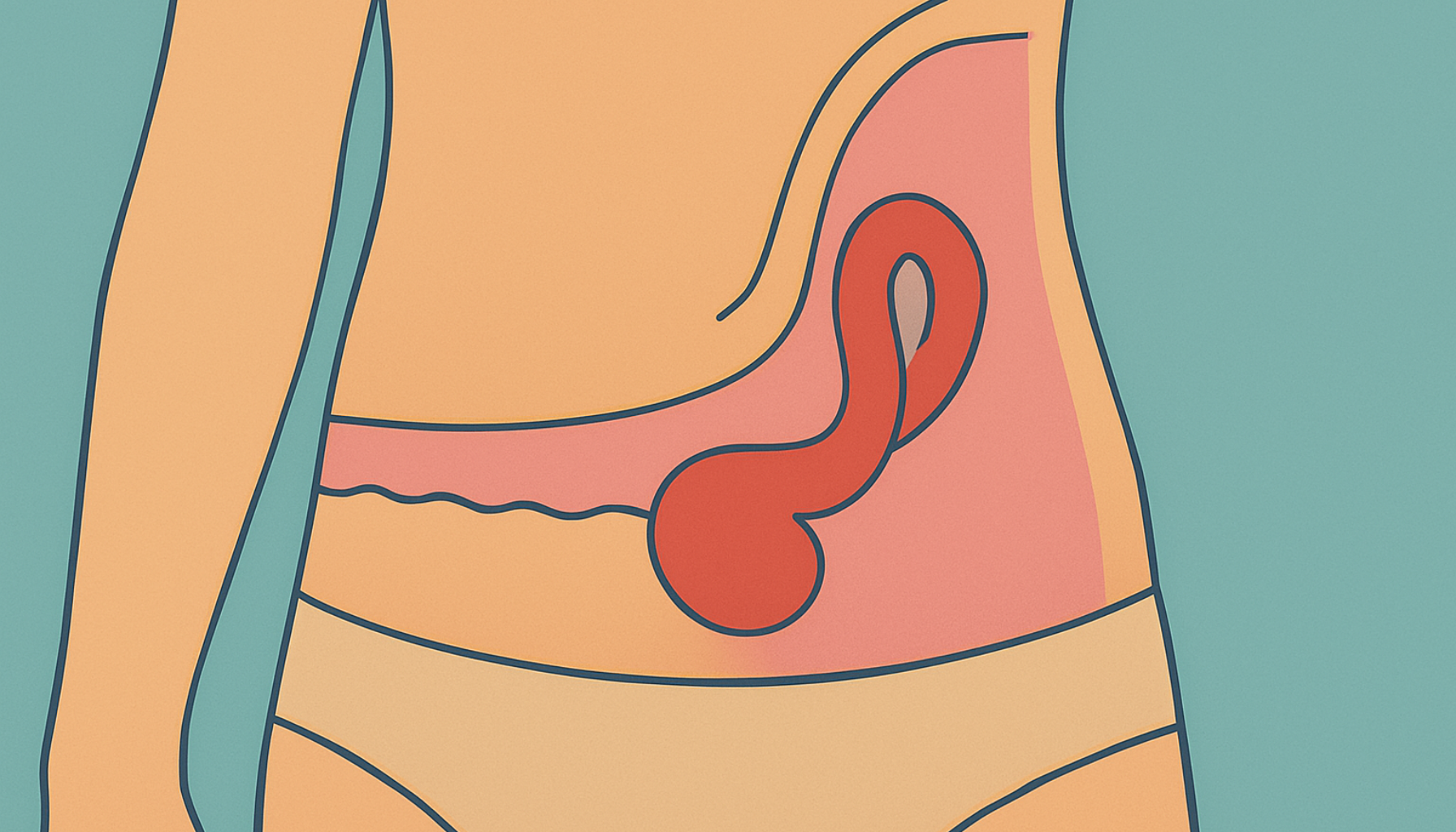 Brokk – Symptomer, typer og behandling 13 Illustrasjon av brokk i magen som viser utposning av tarm gjennom bukveggen hos en person med undertøy.