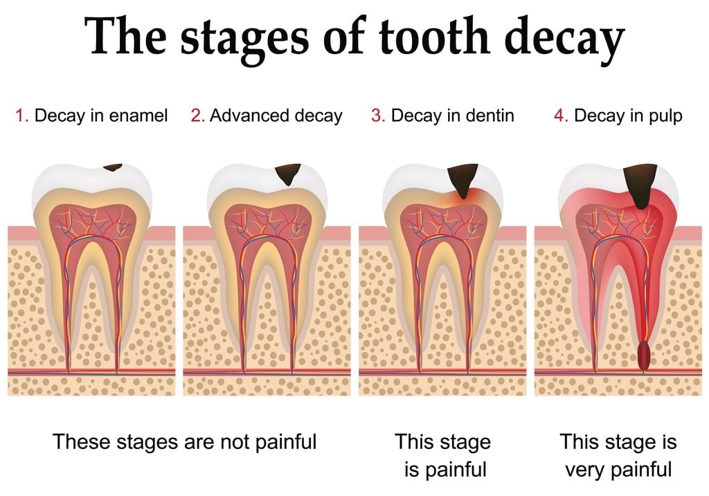 the stages of tooth decay