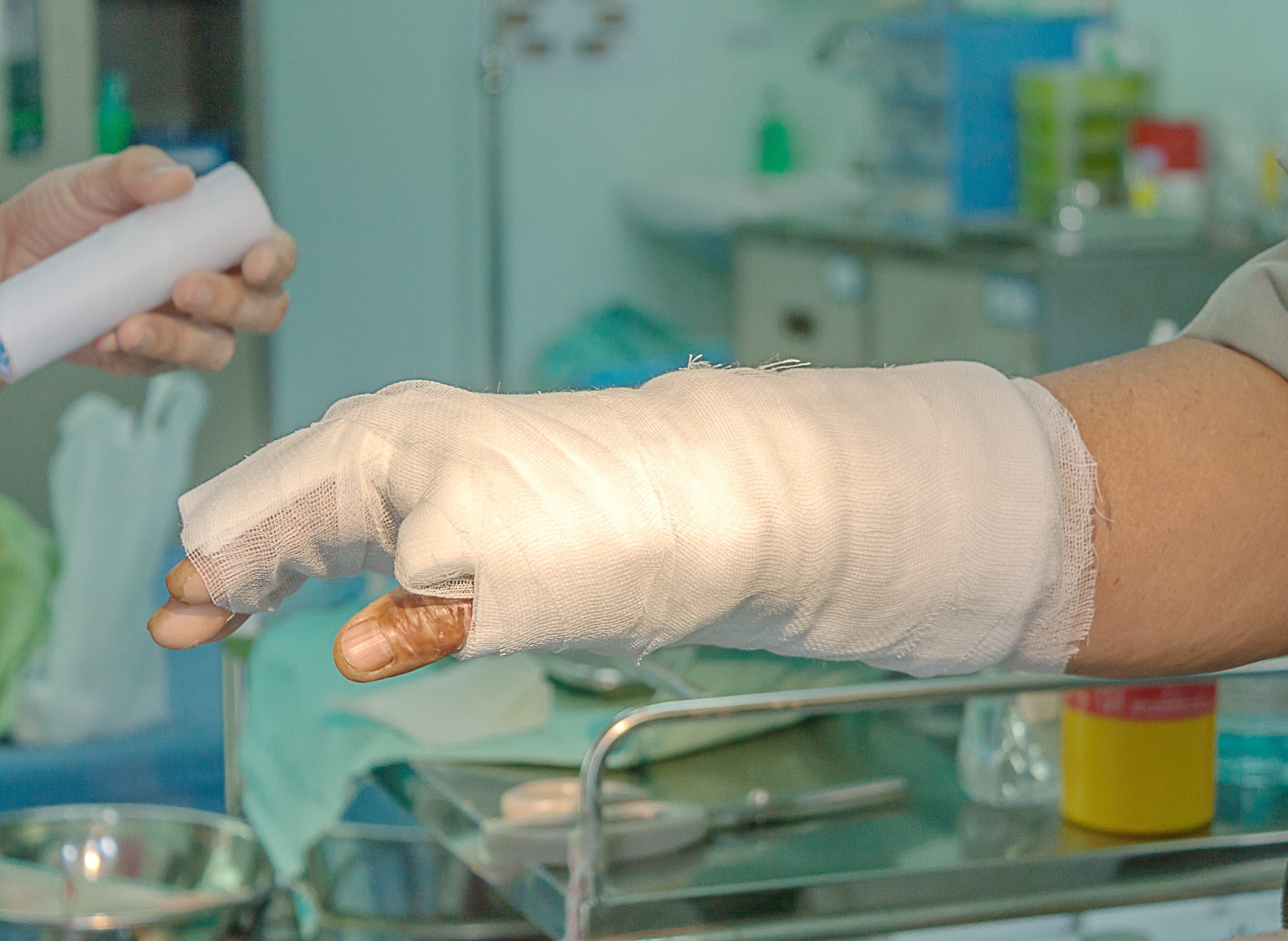 Workplace burns result in a man's hand being wrapped in gauze 