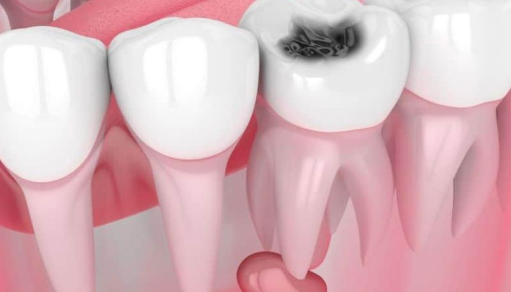 Illustrasjon av jeksel med tydelig karies/hull.