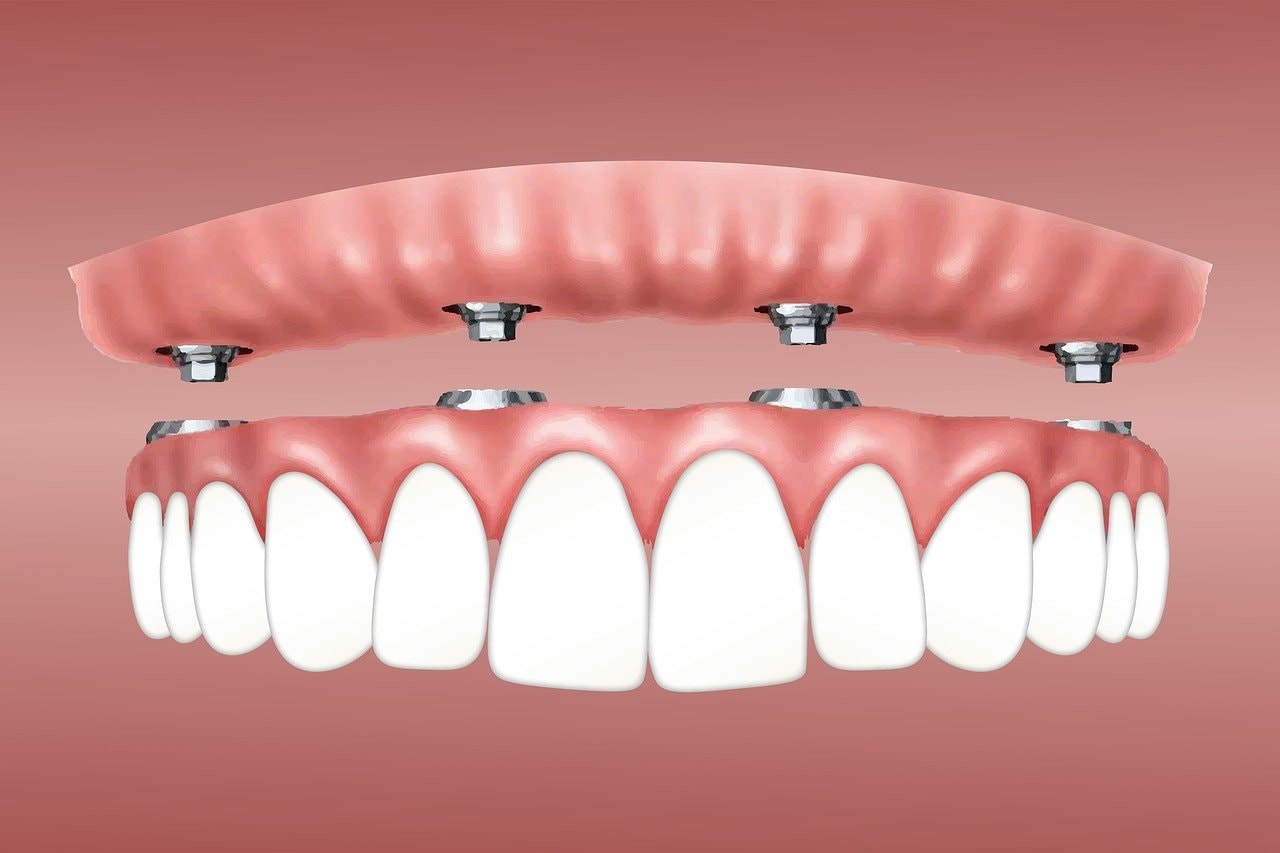 A diagram explaining the bone grafting procedure for dental implants.