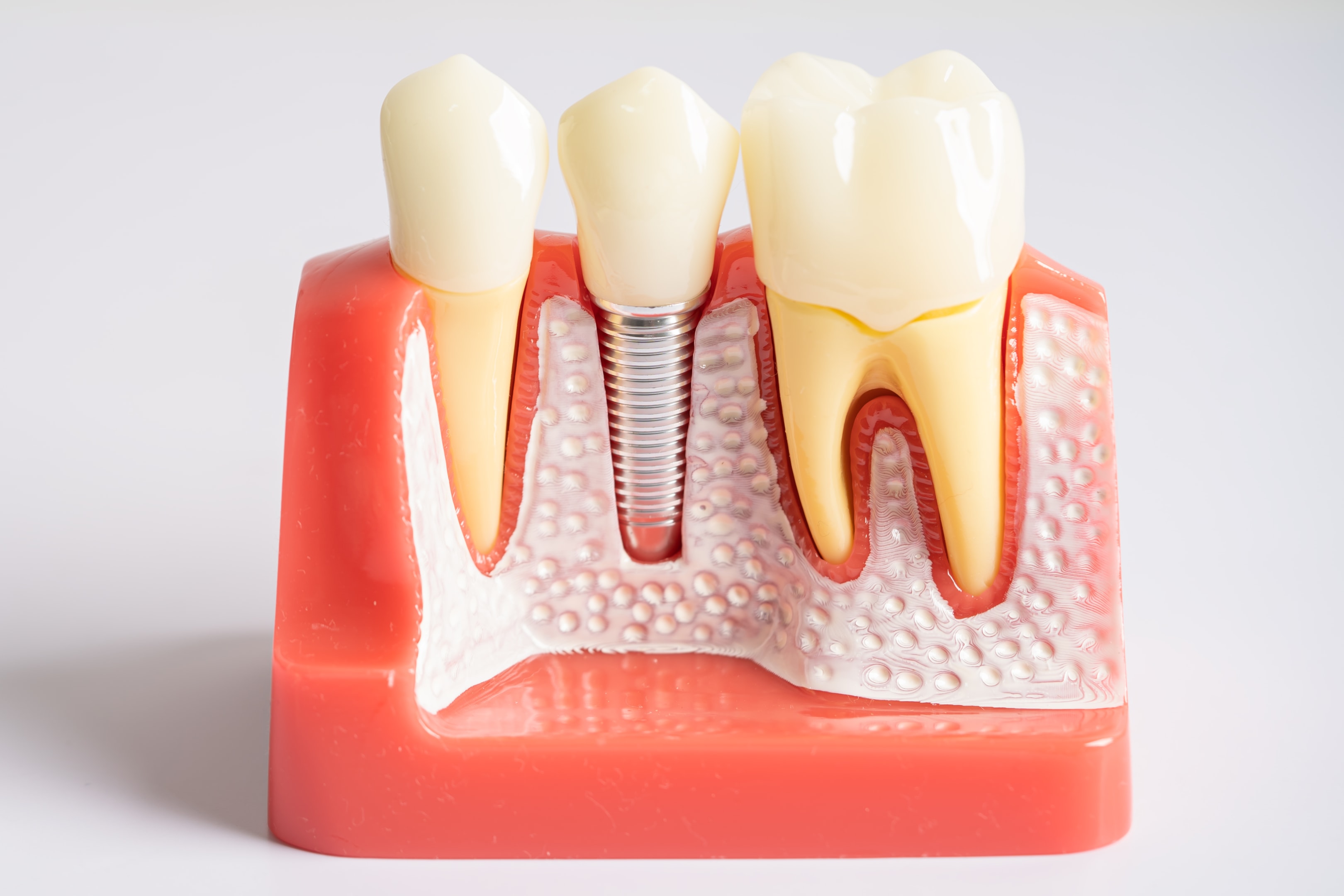 Dental model showing a dental implant