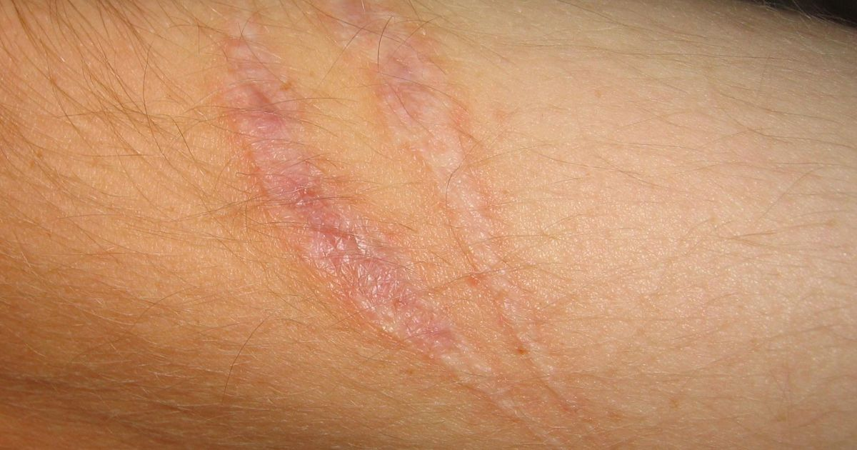 A person with a scar on their arm