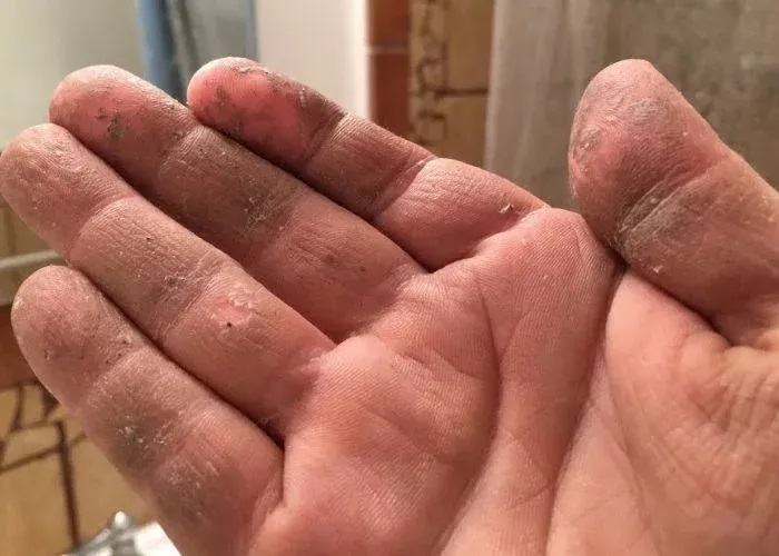 How to get polyurethane off hands