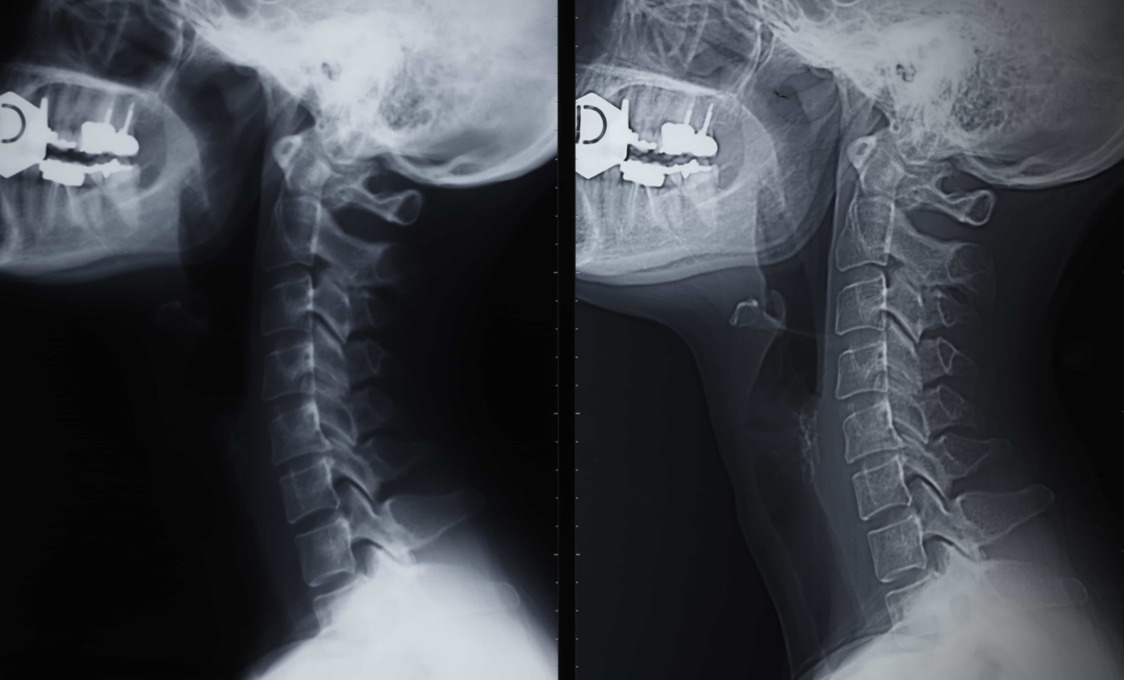 x-ray's showing side by side neck images