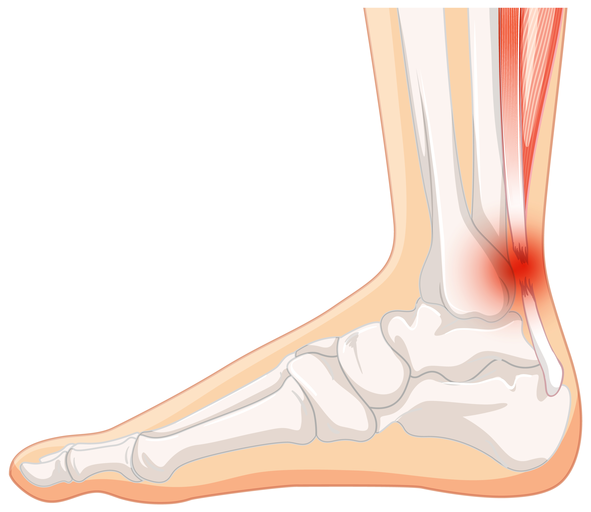 flat foot, va rates flat feet