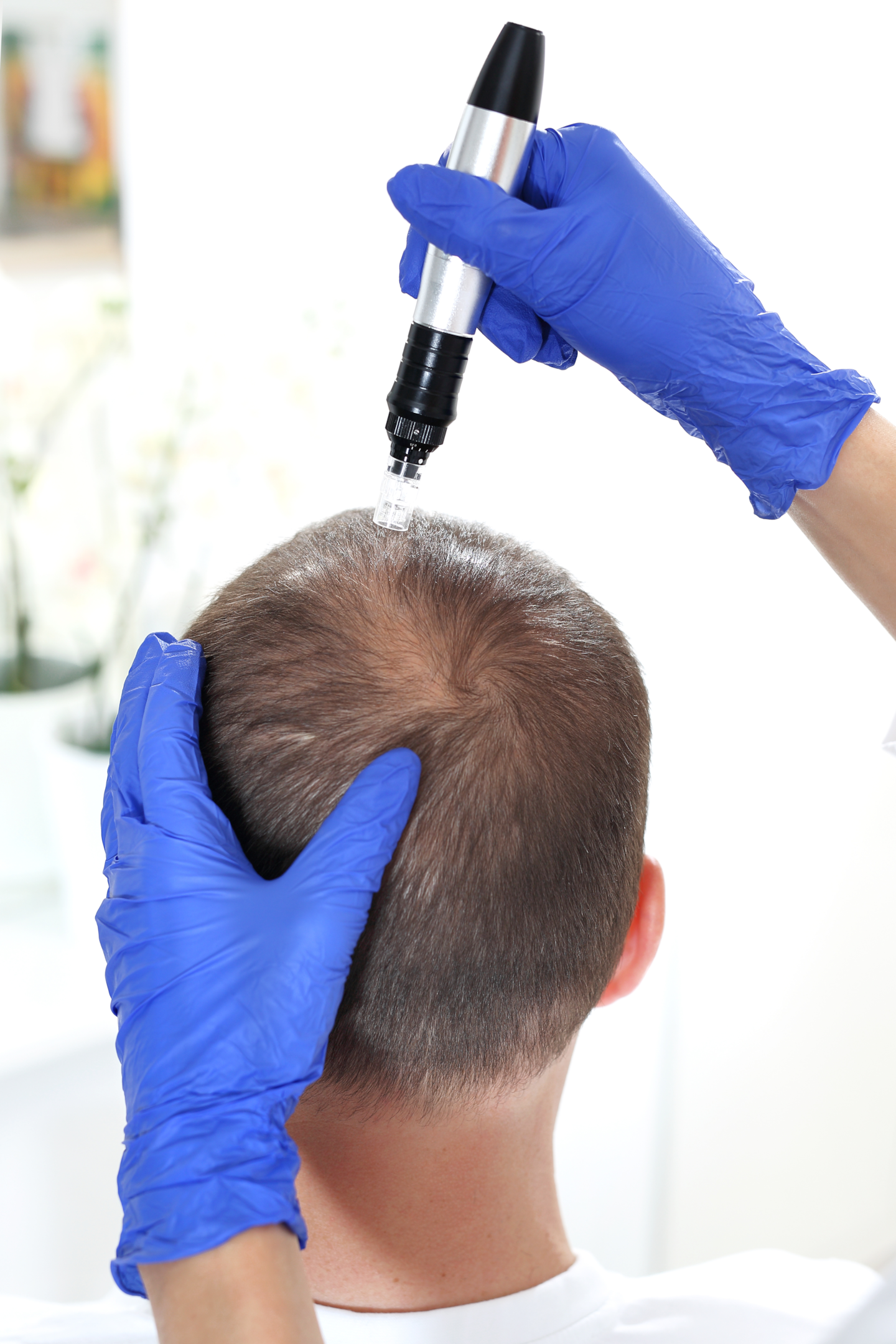 A man getting scalp microneedling treatment in a clinic