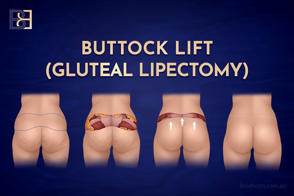 Buttock lift (gluteal lipectomy)