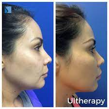 Ultherapy is a non-invasive procedure that uses ultrasound technology to  stimulate collagen production to help tighten the… | Ultrasound technology,  Ultherapy, Skin