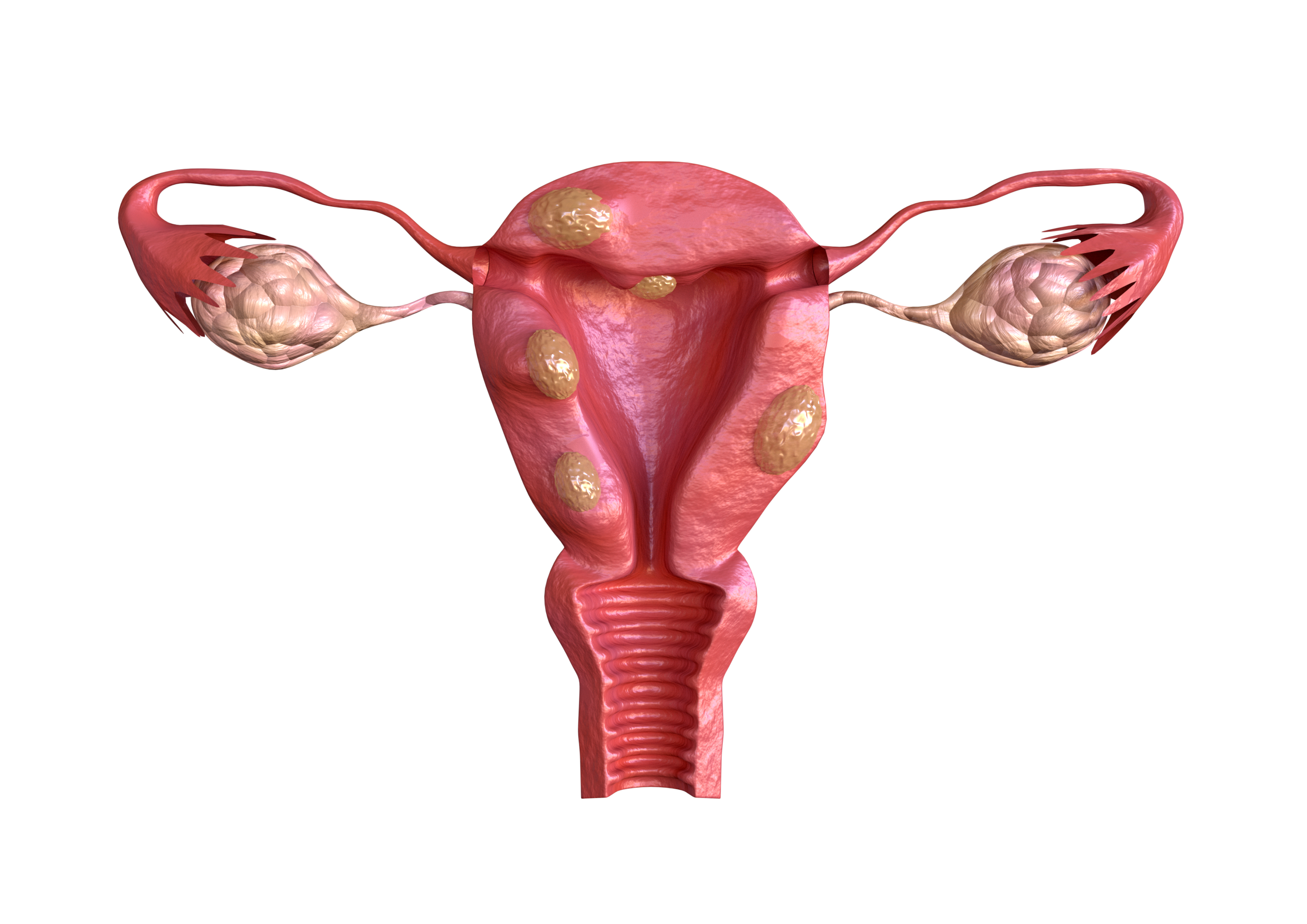 A vector representation of the uterine fibroids.