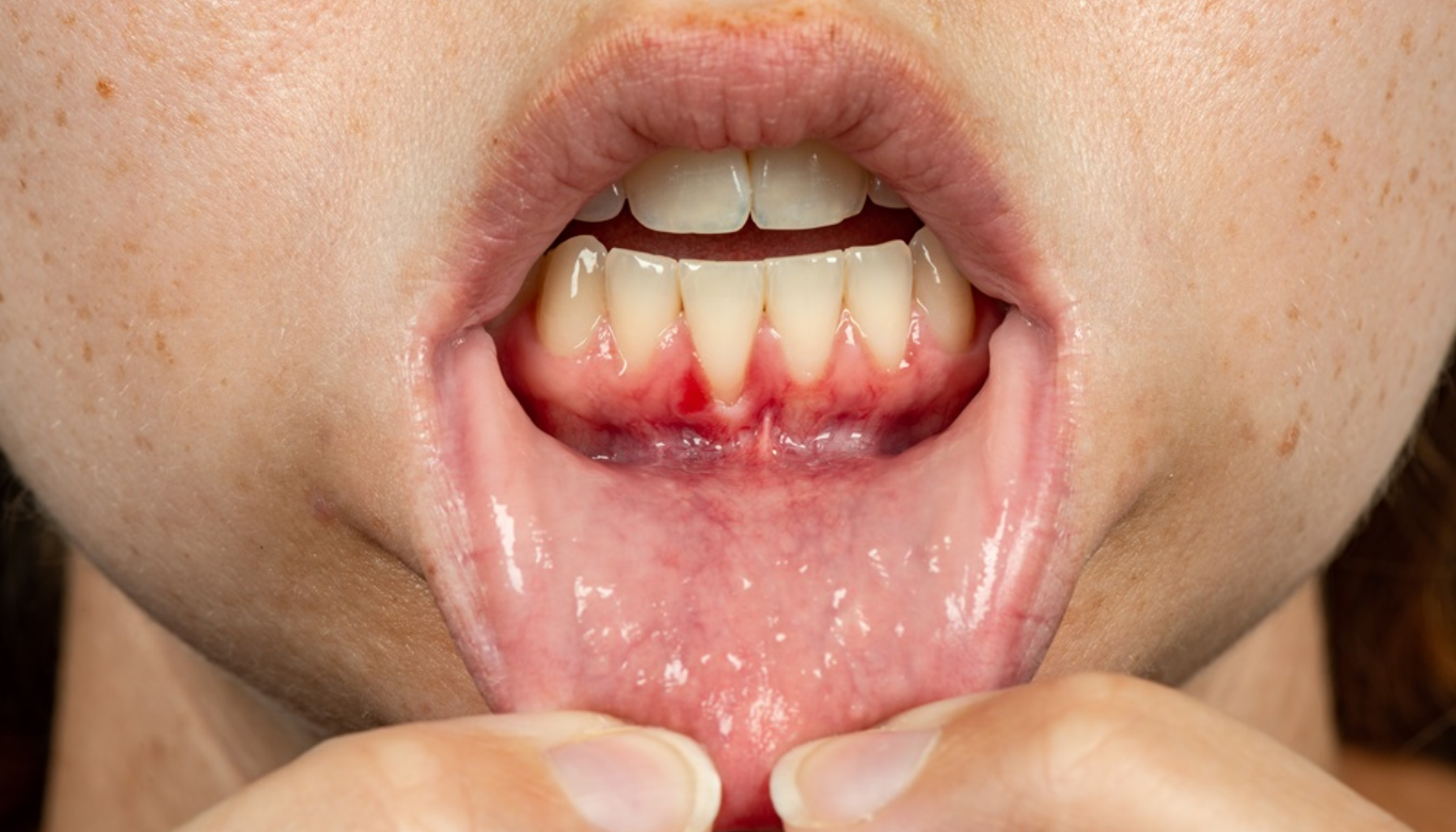 Blemme på Tannkjøttet: Når Små Hevelser Er Et Tegn på Irritasjon eller Infeksjon 15 Nærbilde av betent tannkjøtt i underkjeven mens leppen trekkes ned og rød irritasjon rundt tennene vises tydelig klart blemme på tannkjøttet blemmer i munnen bør du kontakte blemme i tannkjøttet god munnhygiene andre årsaker blemmer pusse tennene munnen to ganger skylle munnen tannkjøttet behandling sår after årsaker munnskold bør ofte tann andre tannlegen tannlege munnhulen unngå dersom mat bruk lindre symptomer oppstår drikke ubehag infeksjon smerter får viktig mer tegn hos fleste eksempel blemmene bakterier god tennene hvite blemme kontakte stress rundt skyldes lege finnes gjøre vanlig smertefulle behandles små redusere munnsår råd skader betennelse dårlig oppstå feber ganger puss vev alvorlige inneholder gel gir alvorlig går raskt smerte vanligste forårsake smertefullt