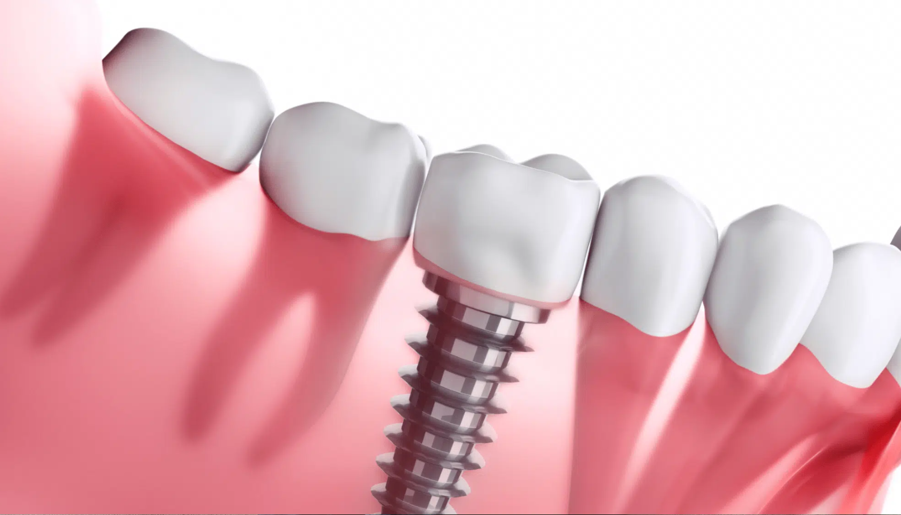 Tannimplantat pris – Hva koster det og hva får du? 11 Illustrasjon av tannimplantat festet i kjevebenet mellom naturlige tenner, viser struktur og plassering i tannkjøttet. 1/2