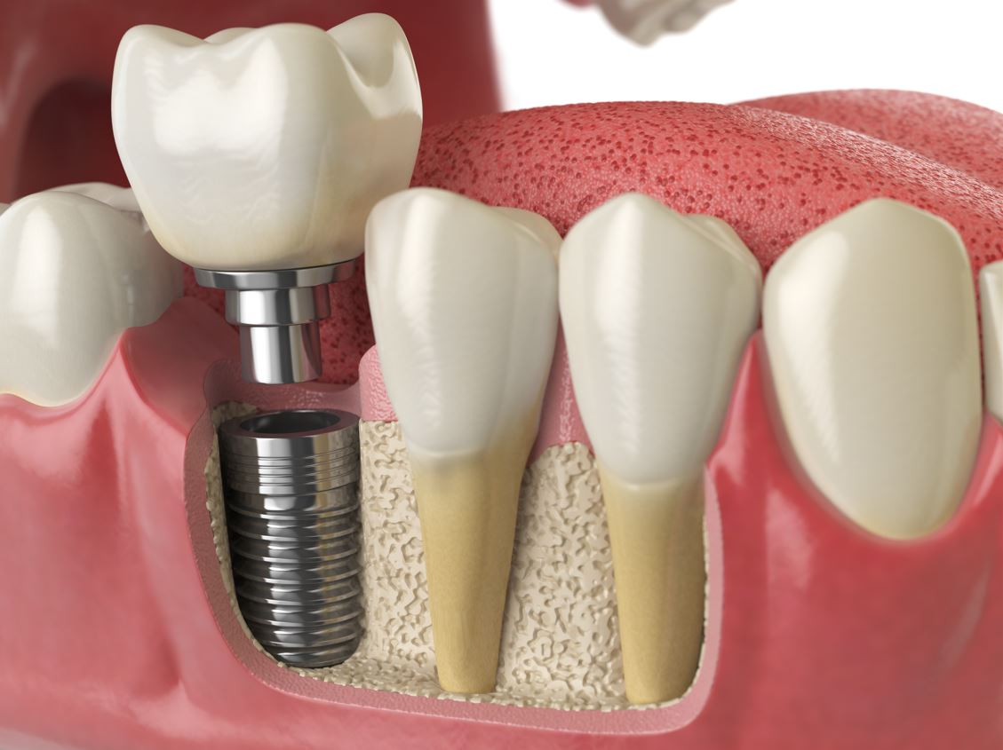 Illustration of chewing and speaking process with dental implants