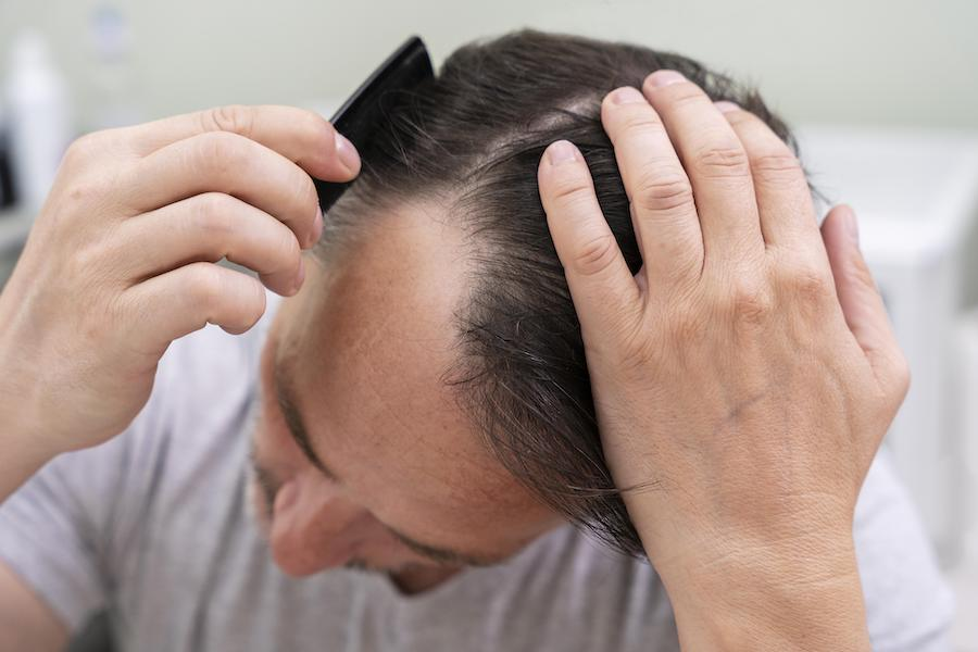 hair thinning on one side