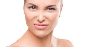 Bunny Lines - What Can You Do About Nose Wrinkles?