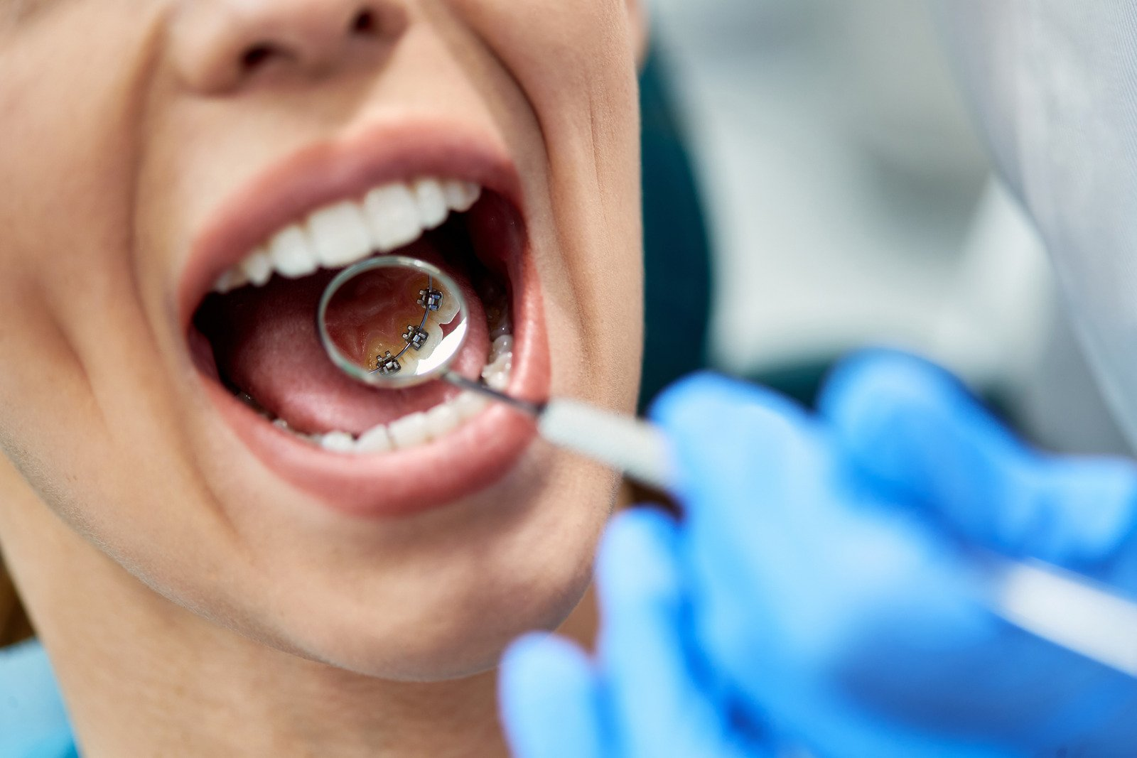 lingual braces, braces treatment