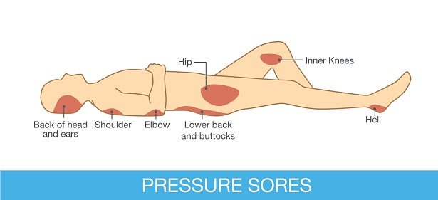 What Is A Pressure Ulcer