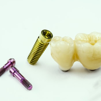 choose screwless dental implants